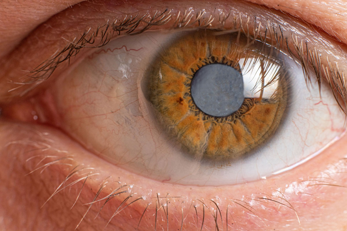 Ohio-Ophthalmology-Eye-Care-Treatment-Of-Cataracts